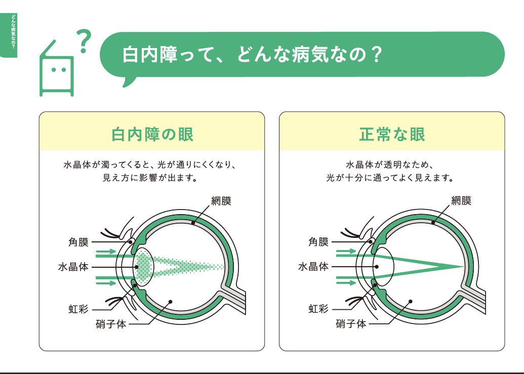 白内障の治療